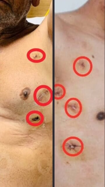 𝗥𝗲𝘃𝗼𝗹𝘂𝘁𝗶𝗼𝗻𝗶𝘇𝗶𝗻𝗴 𝗖𝗮𝗿𝗱𝗶𝗮𝗰 𝗖𝗮𝗿𝗲: 𝗥𝗼𝗯𝗼𝘁𝗶𝗰 𝗛𝗲𝗮𝗿𝘁 𝗦𝘂𝗿𝗴𝗲𝗿𝘆 𝘄𝗶𝘁𝗵 𝗗𝗿. 𝗟𝗮𝗹𝗶𝘁 𝗠𝗮𝗹𝗶𝗸
Traditional heart surgery often raises concerns about large incisions, significant blood loss, and extended recovery periods that may take several weeks. With advancements in medical technology, 𝗥𝗼𝗯𝗼𝘁𝗶𝗰 𝗛𝗲𝗮𝗿𝘁 𝗦𝘂𝗿𝗴𝗲𝗿𝘆 is transforming the way cardiac procedures are performed, offering safer and more efficient treatment options. ❤️🩹
In this video, 𝗗𝗿. 𝗟𝗮𝗹𝗶𝘁 𝗠𝗮𝗹𝗶𝗸, 𝗮 𝗵𝗶𝗴𝗵𝗹𝘆 𝗲𝘅𝗽𝗲𝗿𝗶𝗲𝗻𝗰𝗲𝗱 𝗥𝗼𝗯𝗼𝘁𝗶𝗰 𝗮𝗻𝗱 𝗠𝗜𝗖𝗦 (𝗠𝗶𝗻𝗶𝗺𝗮𝗹𝗹𝘆 𝗜𝗻𝘃𝗮𝘀𝗶𝘃𝗲 𝗖𝗮𝗿𝗱𝗶𝗮𝗰 𝗦𝘂𝗿𝗴𝗲𝗿𝘆) 𝘀𝗽𝗲𝗰𝗶𝗮𝗹𝗶𝘀𝘁 𝗮𝘁 𝗠𝗮𝗻𝗶𝗽𝗮𝗹 𝗛𝗼𝘀𝗽𝗶𝘁𝗮𝗹𝘀, explains the key advantages of this advanced surgical approach.
𝗞𝗲𝘆 𝗕𝗲𝗻𝗲𝗳𝗶𝘁𝘀 𝗼𝗳 𝗥𝗼𝗯𝗼𝘁𝗶𝗰 𝗛𝗲𝗮𝗿𝘁 𝗦𝘂𝗿𝗴𝗲𝗿𝘆:
🔹 𝗠𝗶𝗻𝗶𝗺𝗮𝗹𝗹𝘆 𝗜𝗻𝘃𝗮𝘀𝗶𝘃𝗲 𝗣𝗿𝗼𝗰𝗲𝗱𝘂𝗿𝗲
Only 𝟮–𝟰 𝘀𝗺𝗮𝗹𝗹 𝗶𝗻𝗰𝗶𝘀𝗶𝗼𝗻𝘀 (𝟭–𝟮 𝗰𝗺 𝗲𝗮𝗰𝗵) are required on the chest, reducing surgical trauma.
🔹 Enhanced Precision & Control
Advanced 𝗿𝗼𝗯𝗼𝘁𝗶𝗰 𝘁𝗲𝗰𝗵𝗻𝗼𝗹𝗼𝗴𝘆 with high-definition cameras allows surgeons to operate with exceptional accuracy.
🔹 𝗙𝗮𝘀𝘁𝗲𝗿 𝗥𝗲𝗰𝗼𝘃𝗲𝗿𝘆
Patients can often return to normal activities within about 7 days, significantly reducing downtime.
🔹 𝗟𝗼𝘄𝗲𝗿 𝗥𝗶𝘀𝗸 & 𝗟𝗲𝘀𝘀 𝗣𝗮𝗶𝗻
This technique leads to minimal blood loss, reduced pain, and a lower risk of infection compared to traditional open-heart surgery.
Robotic heart surgery represents the future of cardiac care, combining medical expertise with cutting-edge technology to ensure safer procedures and quicker recovery for patients. 🫀✨
📍 𝐋𝐨𝐜𝐚𝐭𝐢𝐨𝐧: 𝐒𝐞𝐜𝐭𝐨𝐫 𝟓, 𝐌𝐚𝐢𝐧 𝐒𝐢𝐤𝐚𝐫 𝐑𝐨𝐚𝐝, 𝐕𝐢𝐝𝐲𝐚𝐝𝐡𝐚𝐫 𝐍𝐚𝐠𝐚𝐫, 𝐉𝐚𝐢𝐩𝐮𝐫
📞 𝐏𝐡𝐨𝐧𝐞: +𝟗𝟏 𝟖𝟖𝟎𝟐𝟖𝟎𝟏𝟑𝟖𝟏
🌐 𝐖𝐞𝐛𝐬𝐢𝐭𝐞: 𝐰𝐰𝐰.𝐝𝐫𝐥𝐚𝐥𝐢𝐭𝐦𝐚𝐥𝐢𝐤.𝐜𝐨𝐦
#RoboticHeartSurgery #CardiacCare #MinimallyInvasiveSurgery #HeartHealth #AdvancedCardiacCare